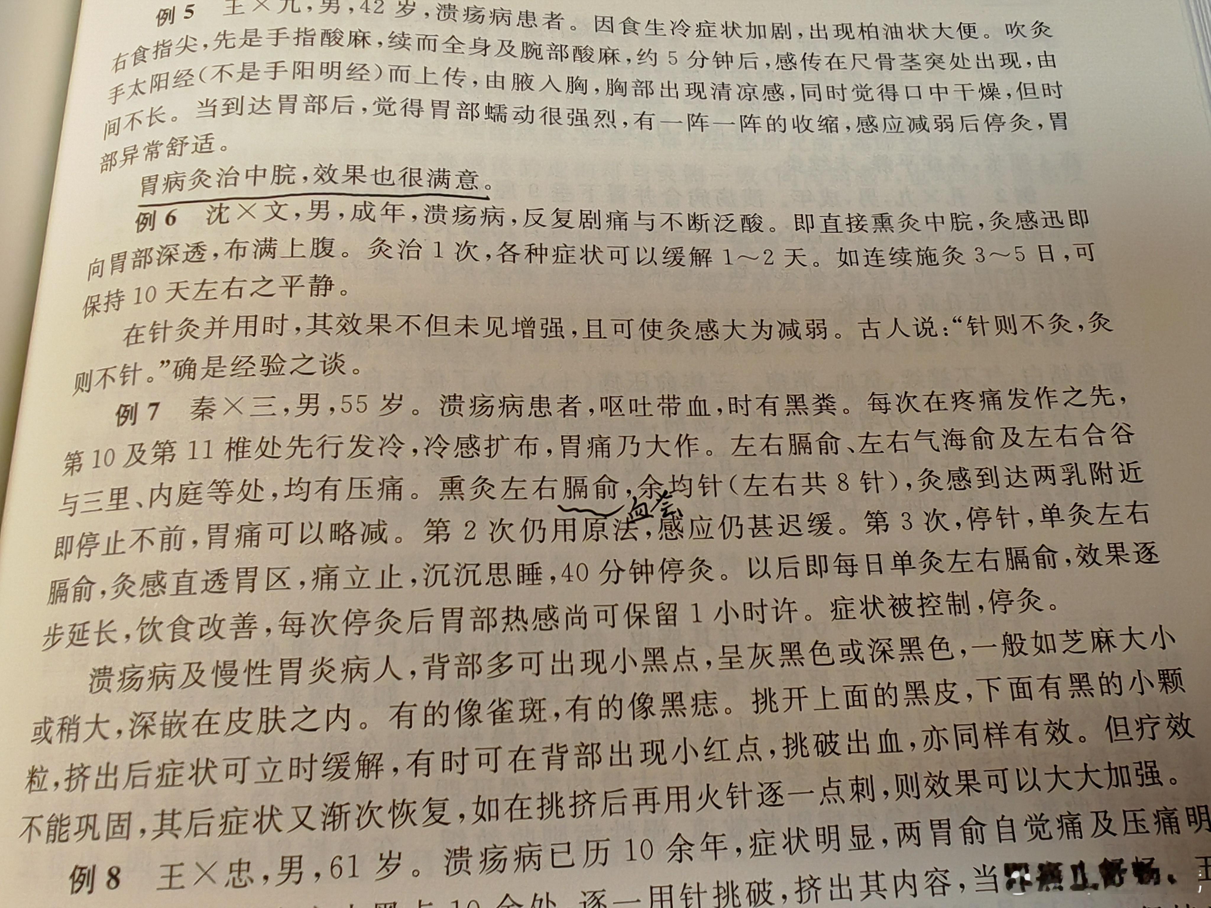 胃病灸中脘 