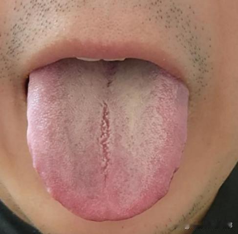 吃不好、睡不好、脾气也不好，光看舌头以为是脾虚，实际上肝郁的问题更严重！

简单