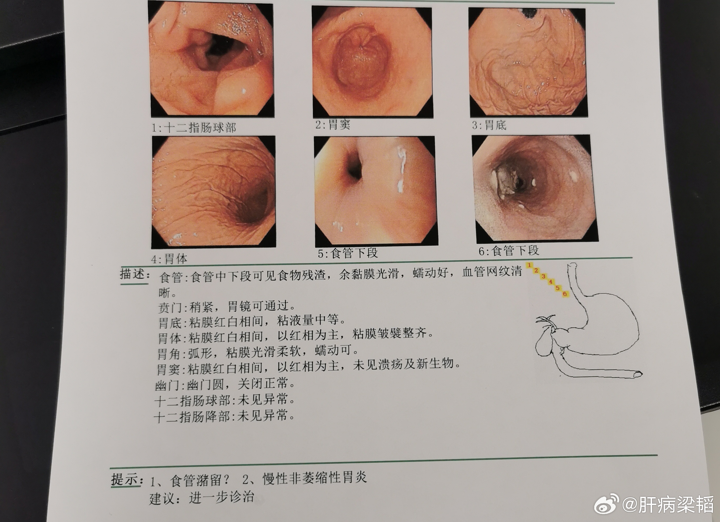 食管潴留是指食物、液体或分泌物在食管内无法正常向下排入胃内，而发生积聚的一种病理