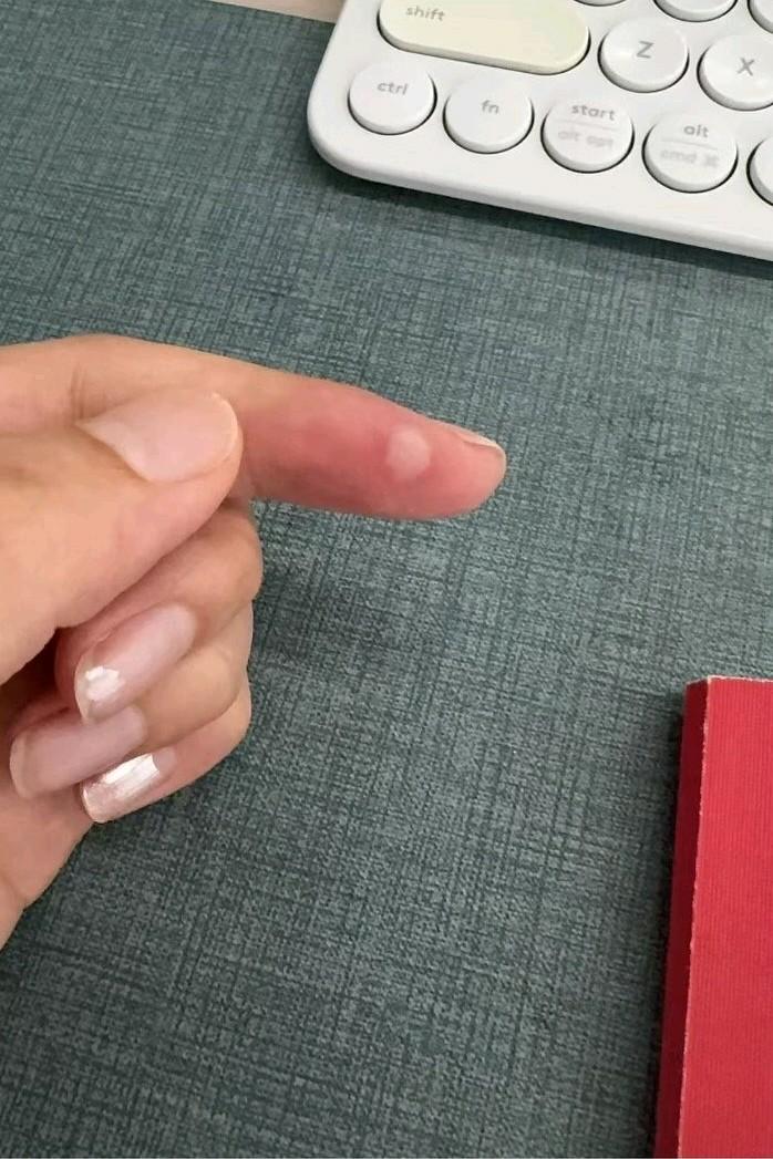 为何拔牙之后，原本烫伤的手指竟立刻恢复了呢？左手食指是中午吃饭时烫伤的，没过多久