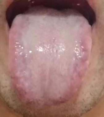 体虚反复难调理，多是虚中夹湿夹瘀，盲目进补适得其反







收到一位粉丝的