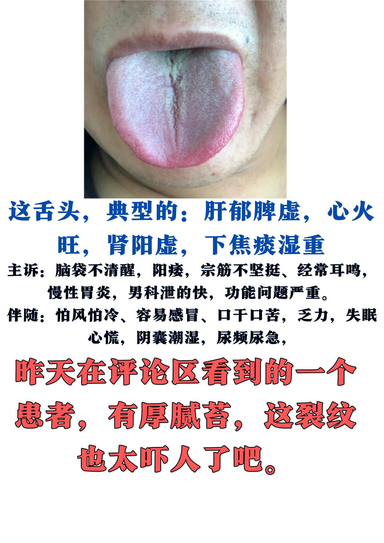 你遇到这样的舌头吗？肾阳虚，肝郁脾虚，下焦湿热谈始终，身体都这样了还是乱吃中成，