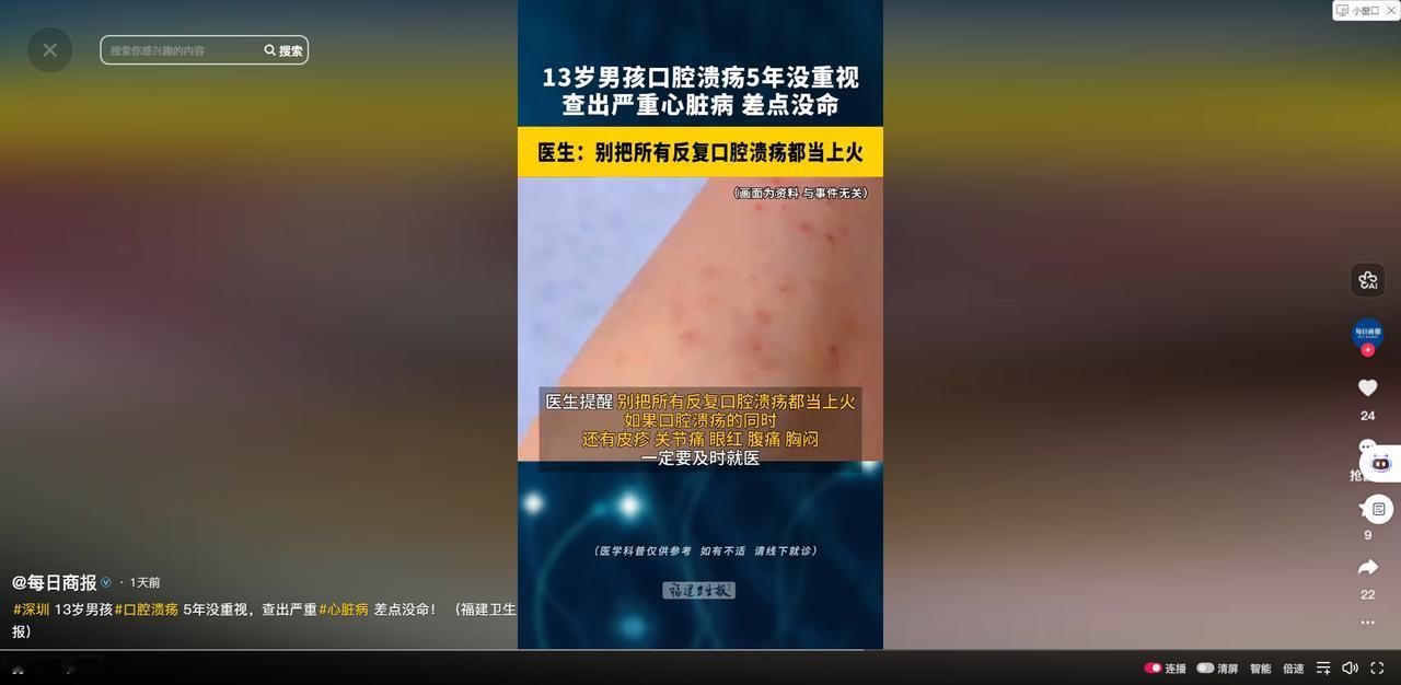万万没想到！5月27日每日商报报道，广东深圳，有个男孩反复患上口腔溃疡，嘴巴和舌