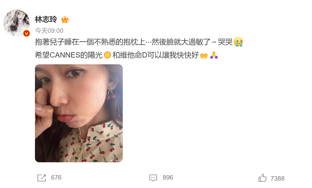 林志玲抱儿子睡在抱枕上导致脸过敏了林志玲 林志玲发博：“抱著兒子睡在一個不熟悉的