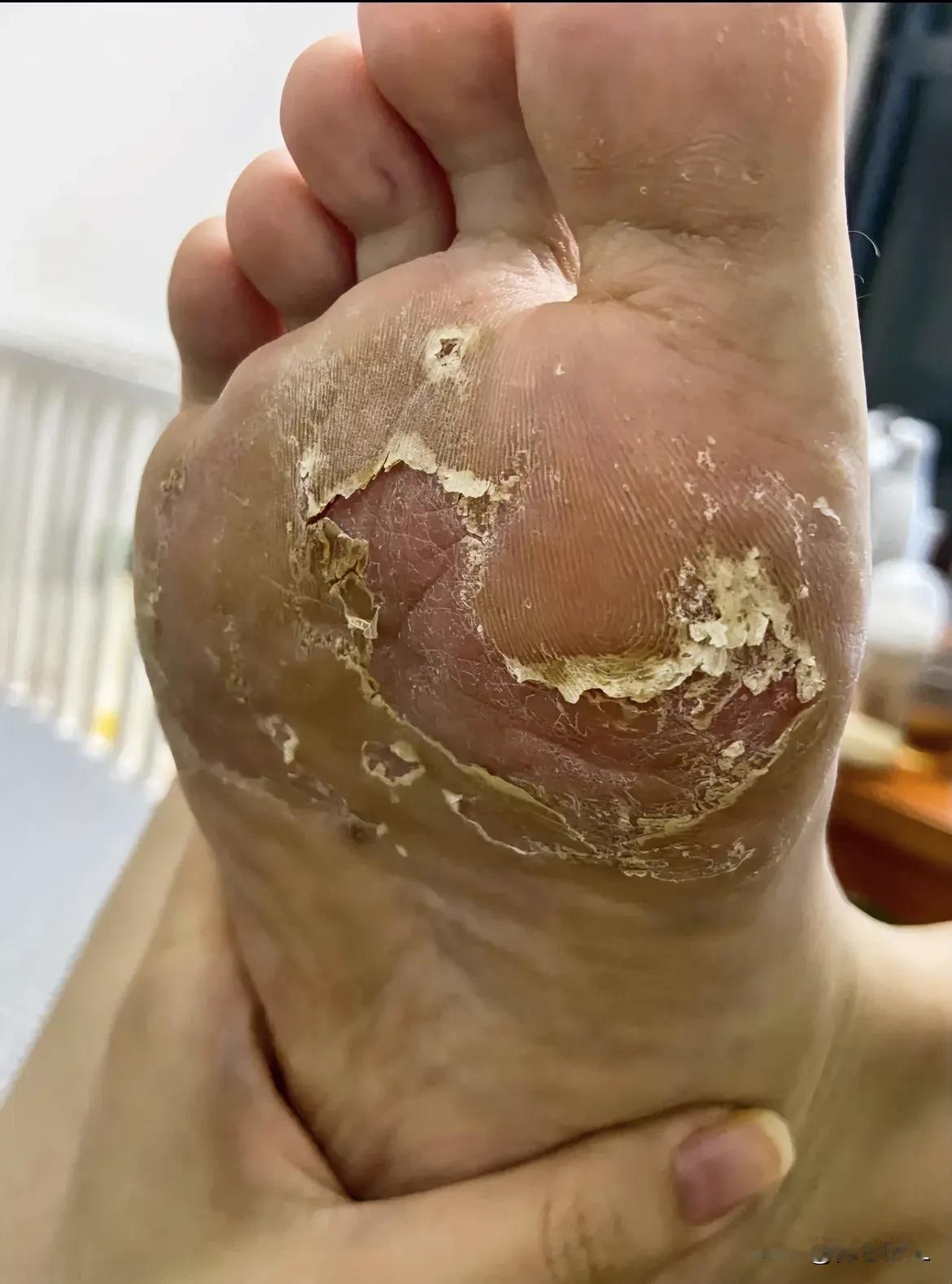 有同事说她走路脚特别疼！查出汗勹疹一年多了，期间尝试很多种膏药涂抹，仍旧不见好转
