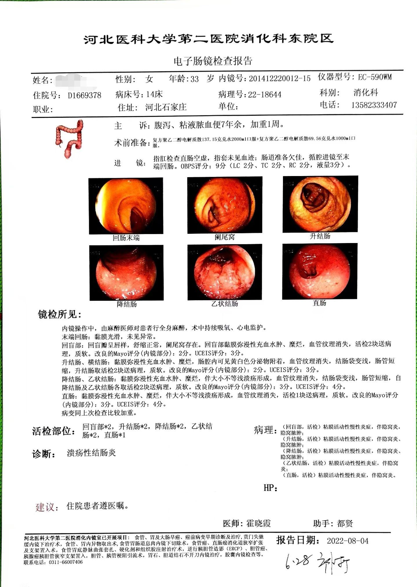 有妊娠需求的全结肠中重度溃结患者肠镜愈合。患者多年全结肠中重度溃结，用...