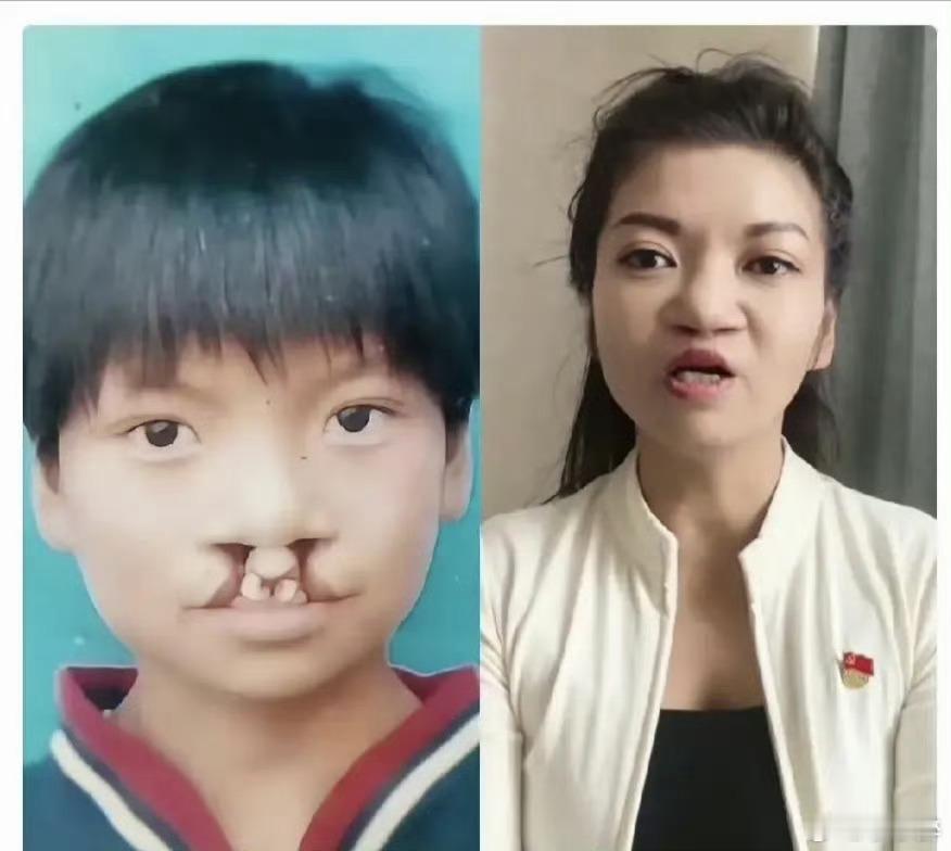 难道这就是所谓的人情冷暖？偶然间刷到一个女孩的直播，她曾深受重度唇腭裂之苦，即便