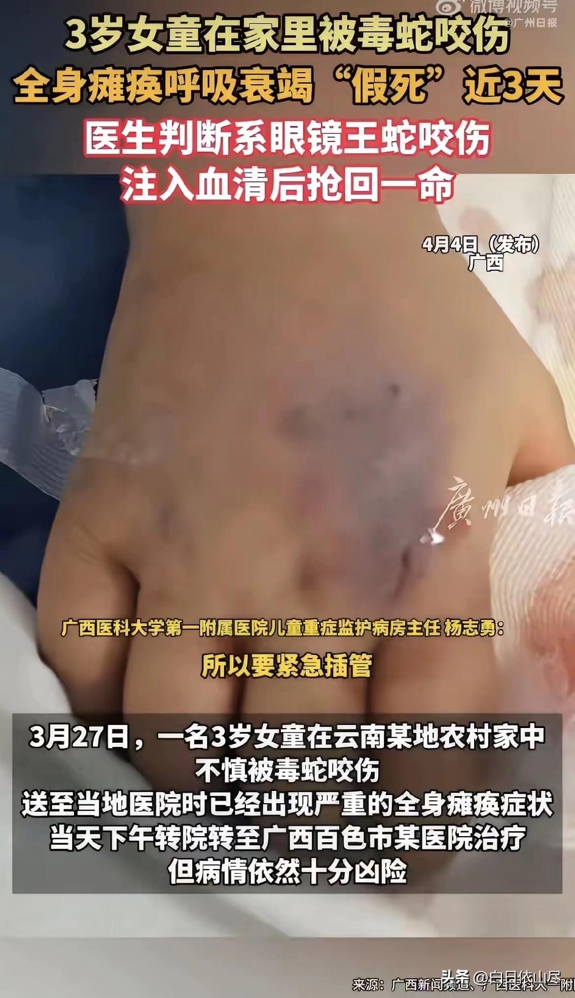 一个三岁小女孩，中午十二点在云南文山家里玩，被眼镜王蛇给咬了。半小时送到医院，人