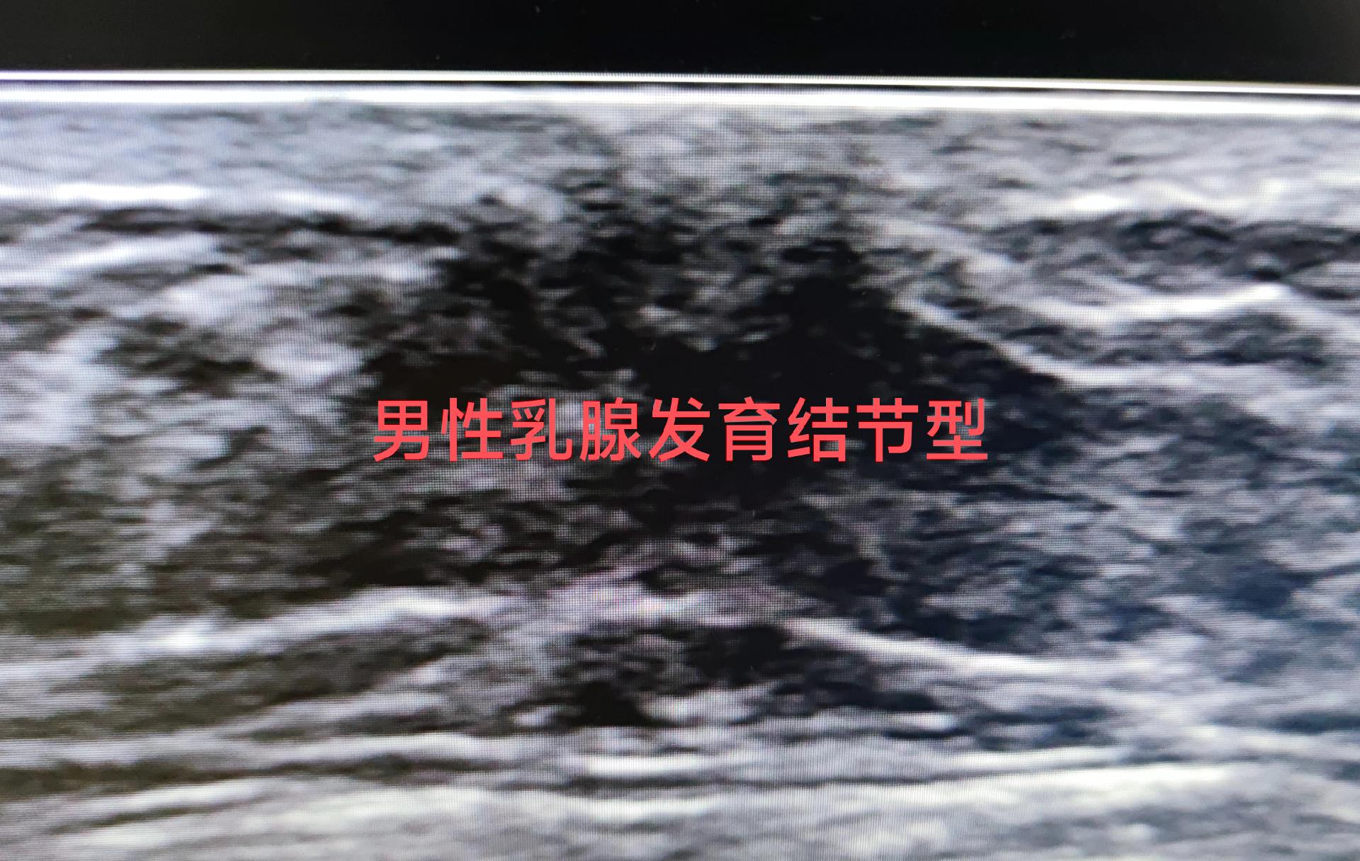 男性乳腺发育。男性乳腺发育，结节型
男，88岁
自觉双乳胀痛，有包块
双乳晕下见结节