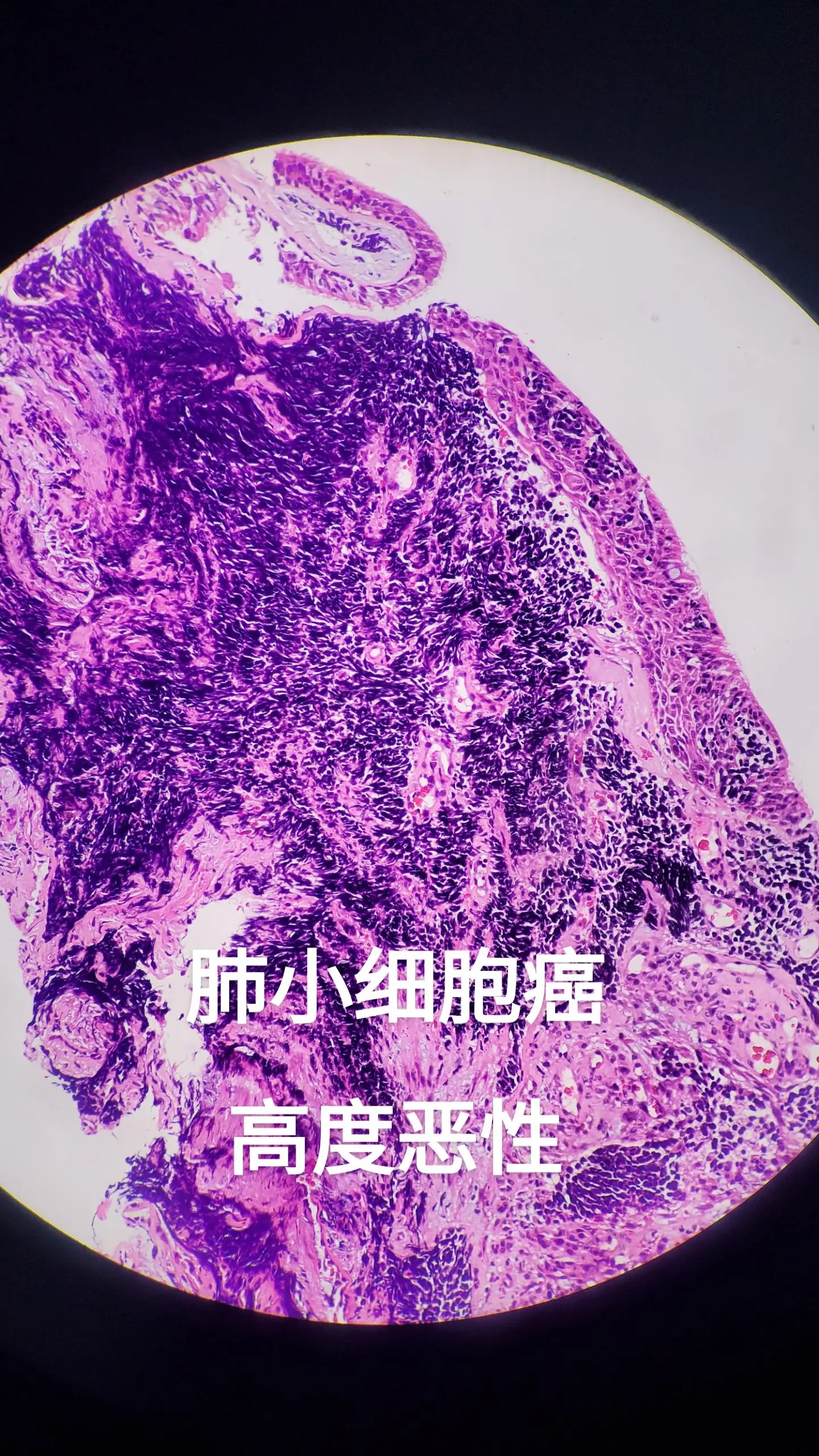 小细胞癌