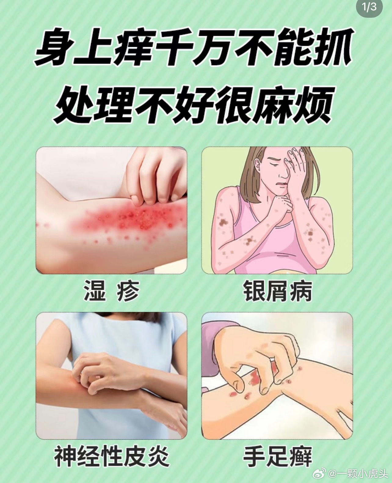 发现自己得了皮肤病一点要去医院治疗，很多皮肤病症状相似但治疗方向是完全不一样的.