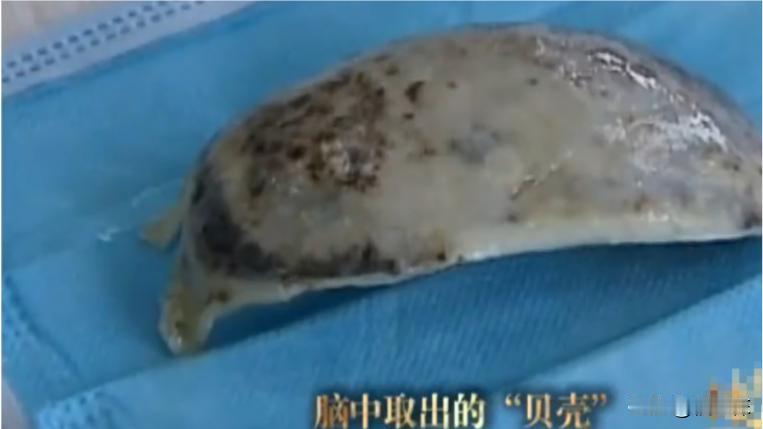 2007年，重庆一14岁男孩突然开始抽搐，还发出奇怪的狗叫声，医生束手无策，直到