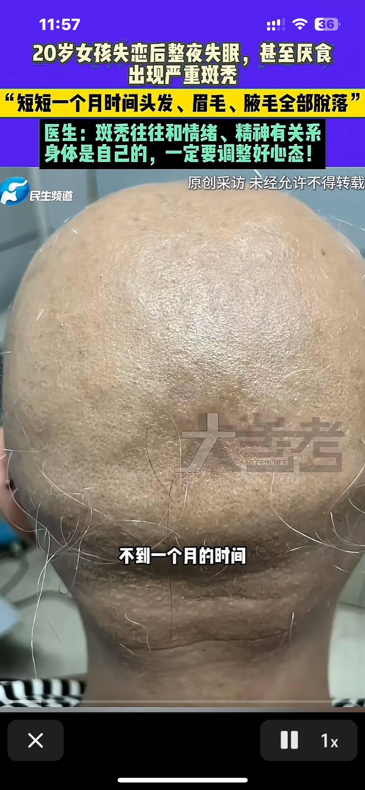 20岁女子被分手后，短短一个月，头发、眉毛、腋毛全部脱落！医生提醒
医生诊断其为