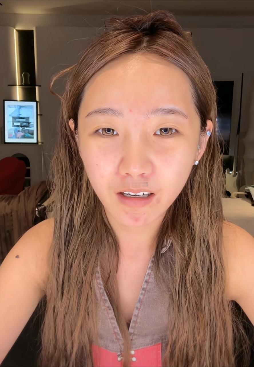 你一脸疙瘩 有空治治吧 别把心思操心和助理和别人吵架了[笑cry][笑cry] 