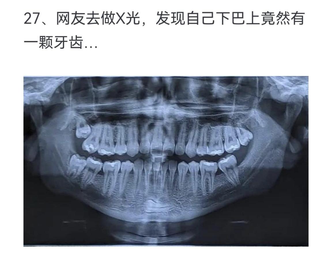 网友去做X光 发现自己下巴上竟然有一颗牙齿