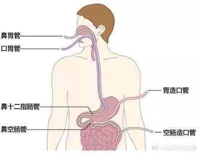 #身患重症时你会放弃吗##国民医生说# 对于癌痛患者，尤其是恶性肿瘤患者，营养不