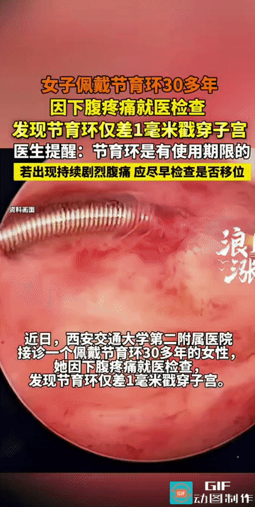 “心疼又吓人！”陕西西安，一位女子因下腹疼痛就医，竟发现体内的节育环已嵌顿变形，