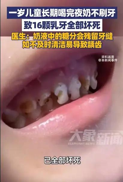 1岁娃16颗乳牙全坏死：被忽视的“夜奶后遗症”
 
医生掰开小乖的嘴巴检查时，眉