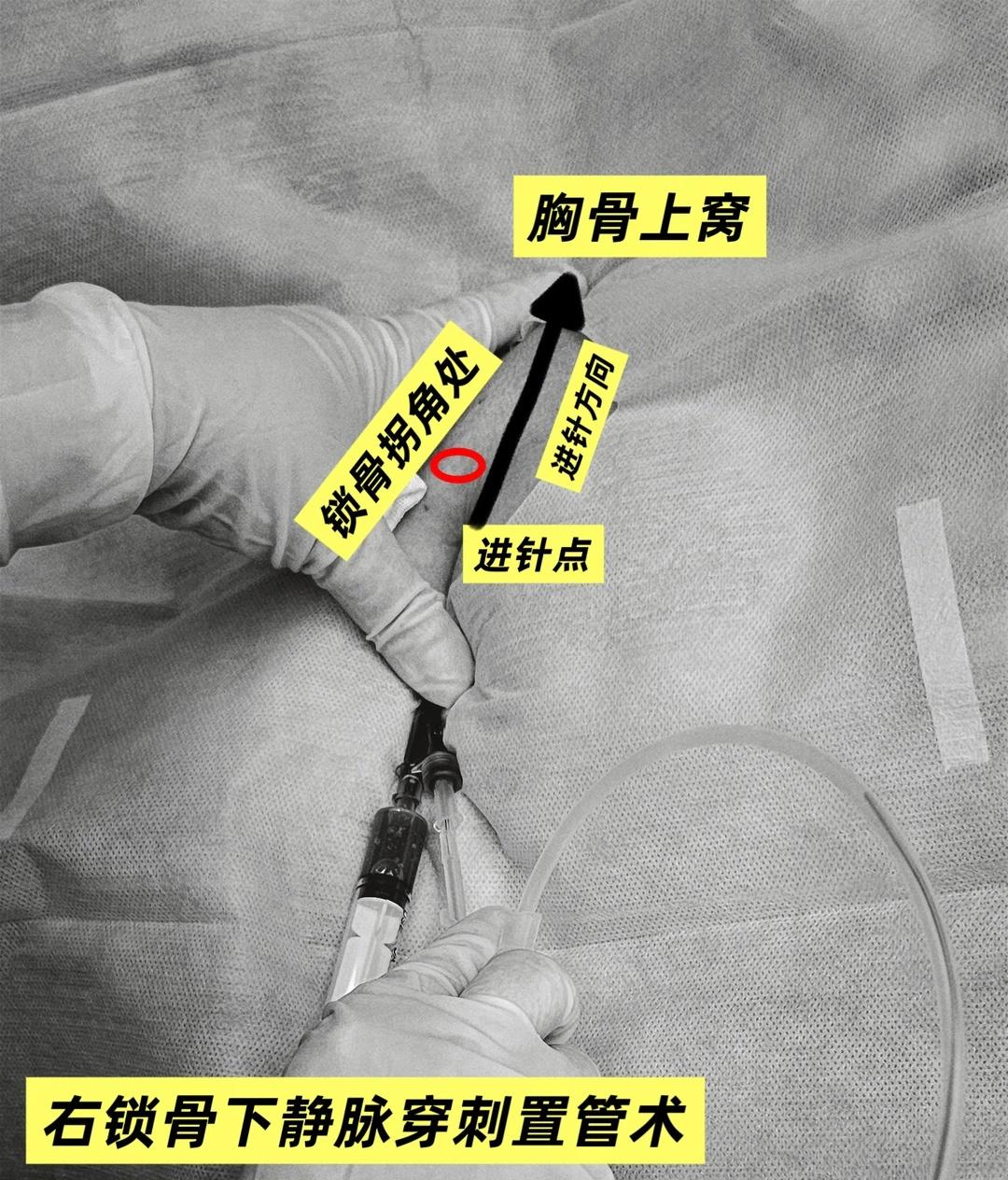 有人说我不务正业好久…那就正业一下…
麻醉医生