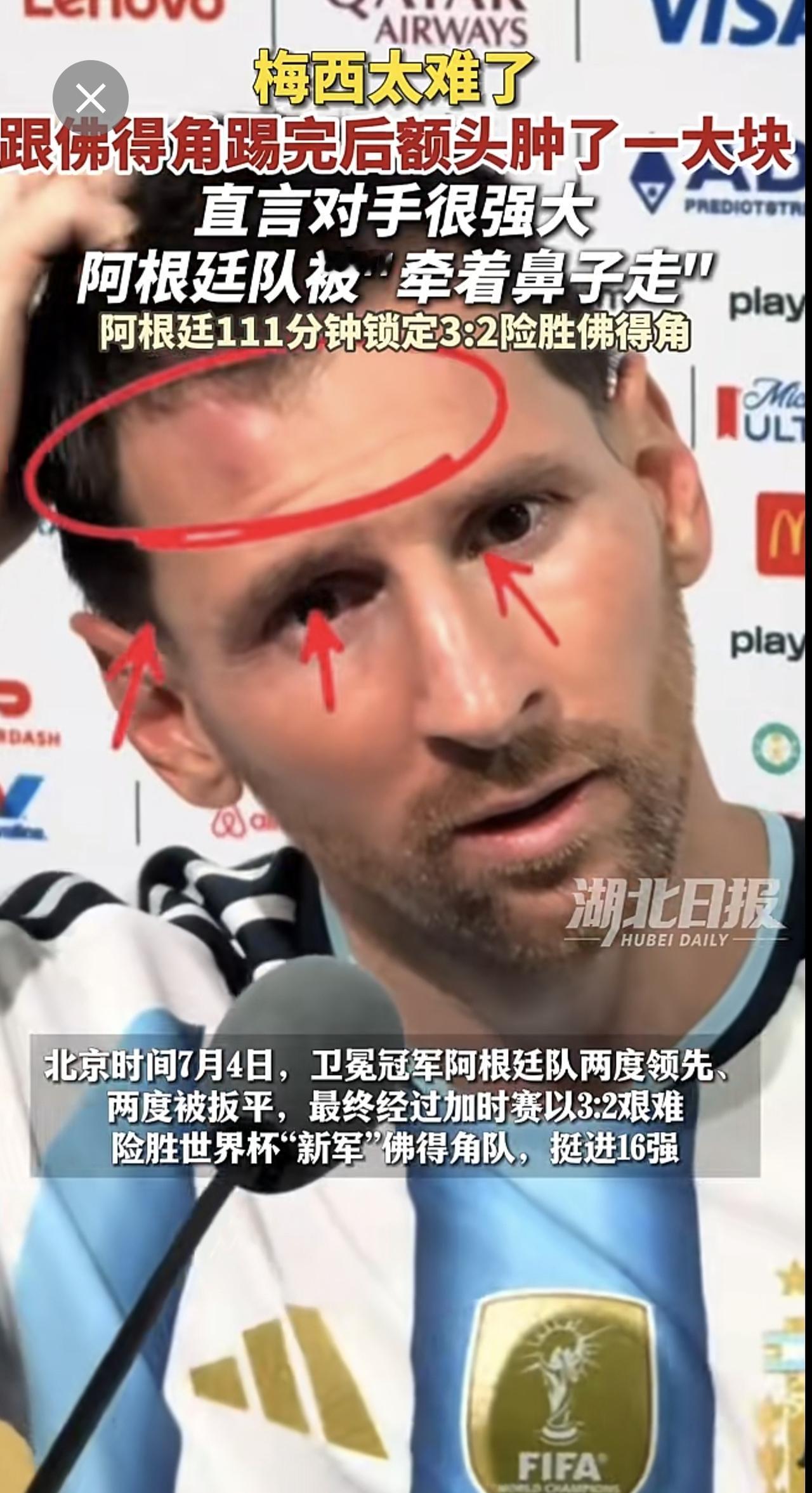 梅西跟佛得角踢完后额头肿了一大块，谈及对手佛得角队，他说：“对手控制着皮球，把我