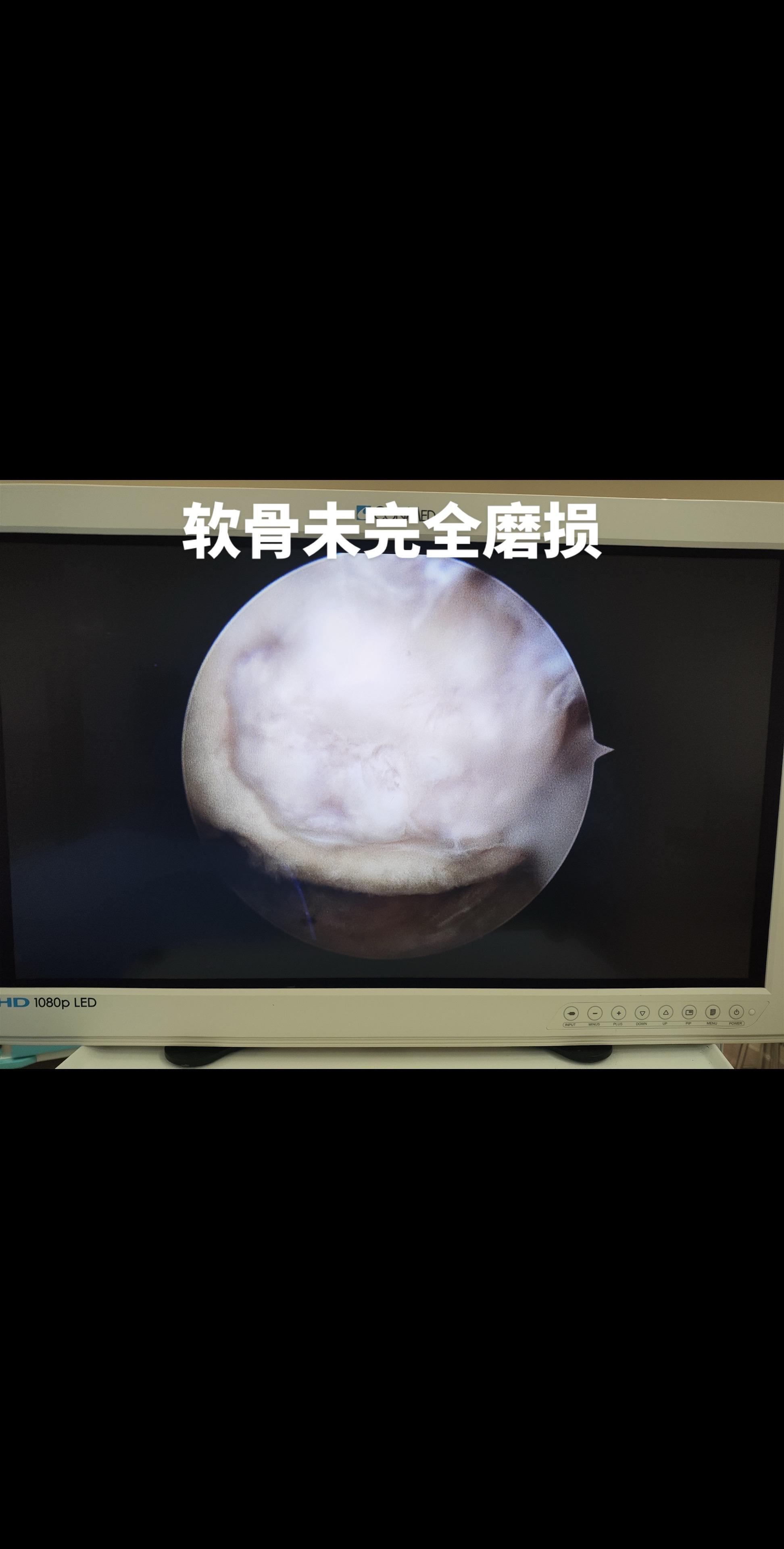 半月板撕裂可长时间不处理会怎么样？