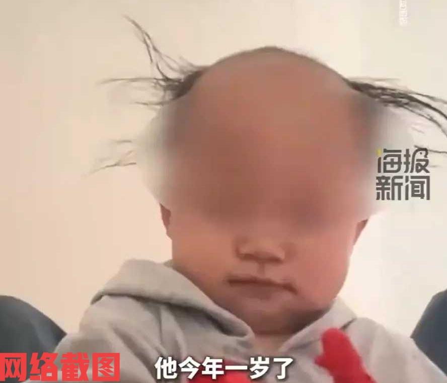 贵州毕节有一岁男孩前额就开始秃了。

为此家里的妈妈还特意带孩子去医院检查，医生