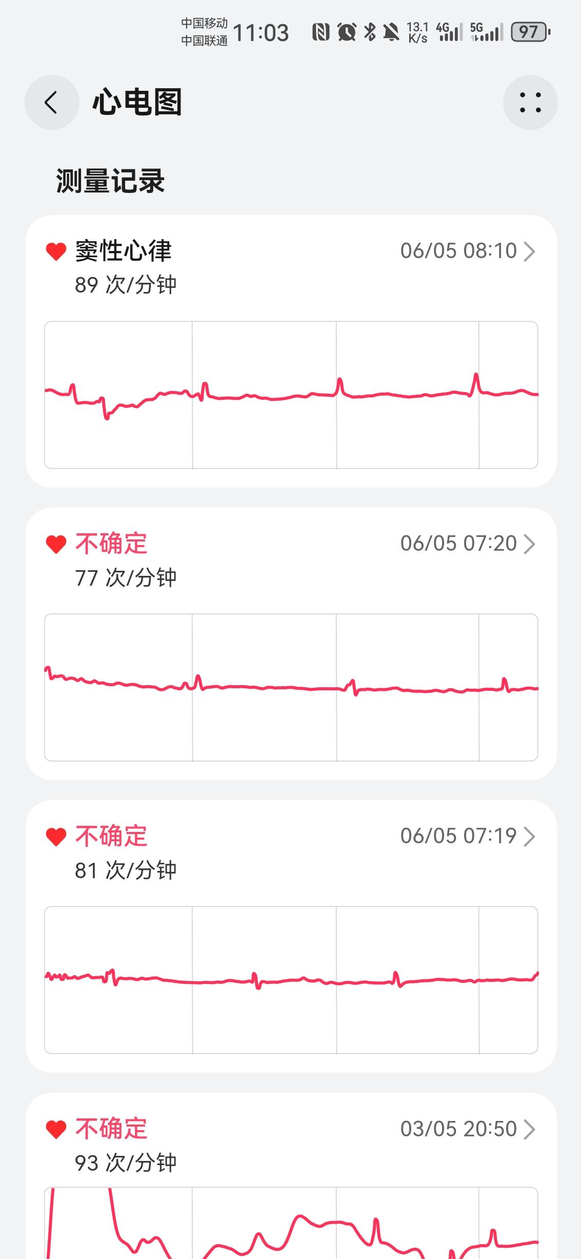房颤患者术后千万不要发火！——分享今天的亲身经历
 
真心奉劝所有房颤术后的病友