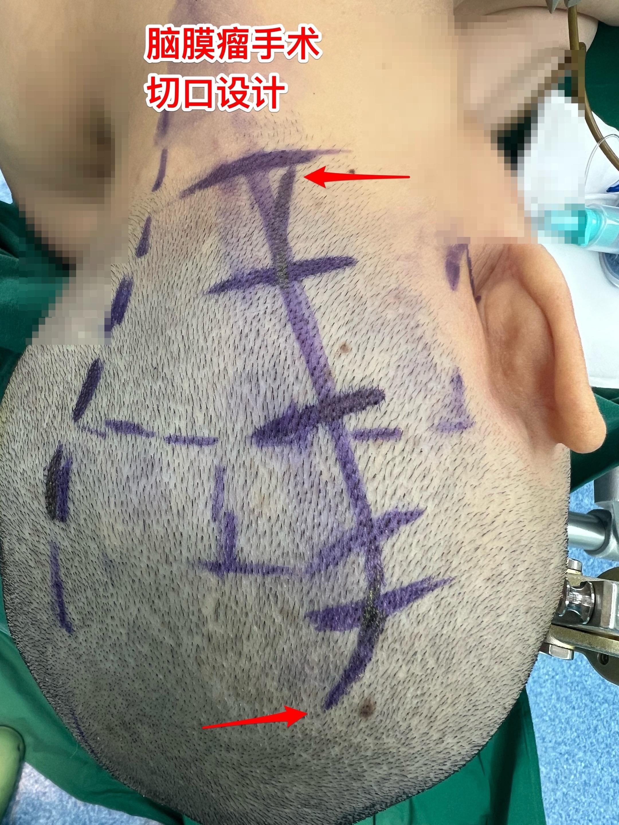 45岁女性因头痛发现脑膜瘤。45岁呼伦贝尔女性，在北京工作。头痛症状不...