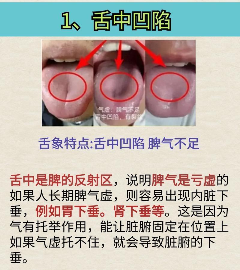 气虚舌象大总结，看看你的舌头有这些特征吗？