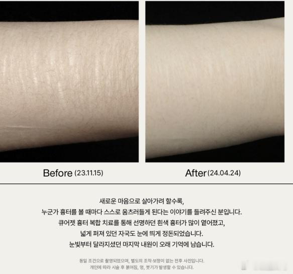 这医院主打的就是已经变成白色的陈旧性膨胀纹/生长纹/妊娠纹，通过 CureJet