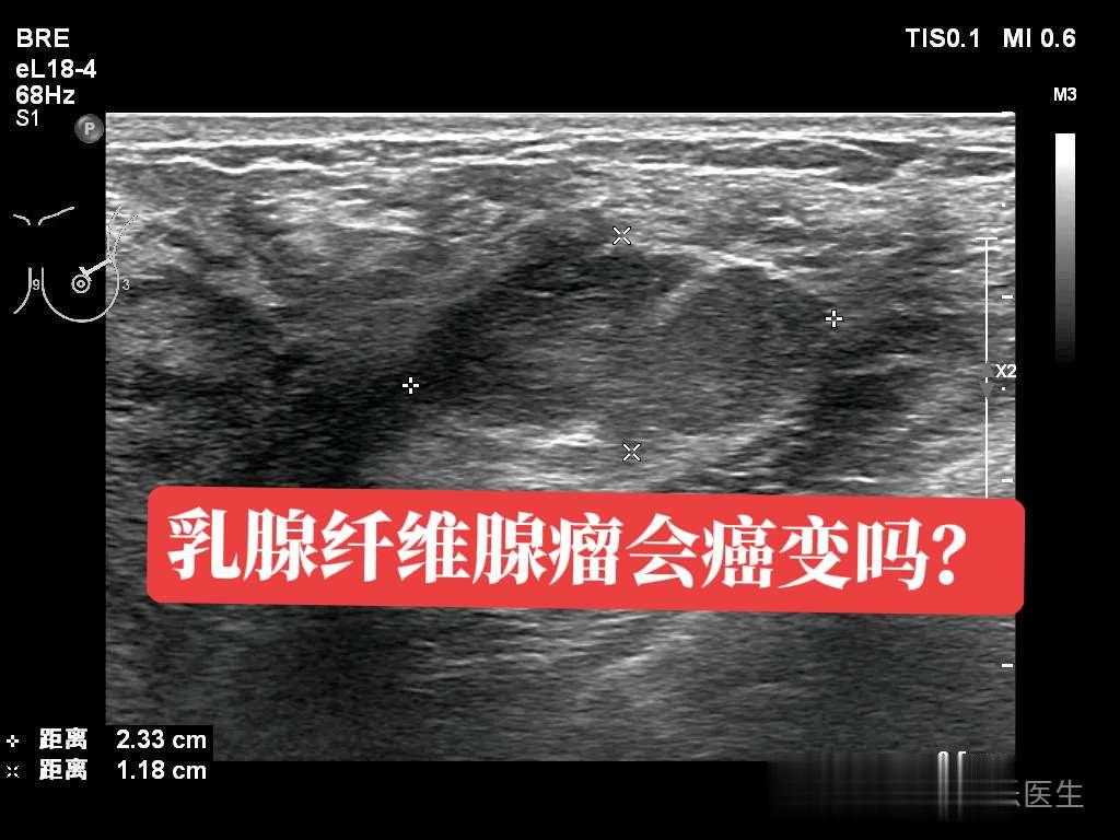 纤维腺瘤会癌变吗？女，33岁，发现双乳结节5年，今年左侧结节生长迅速。...