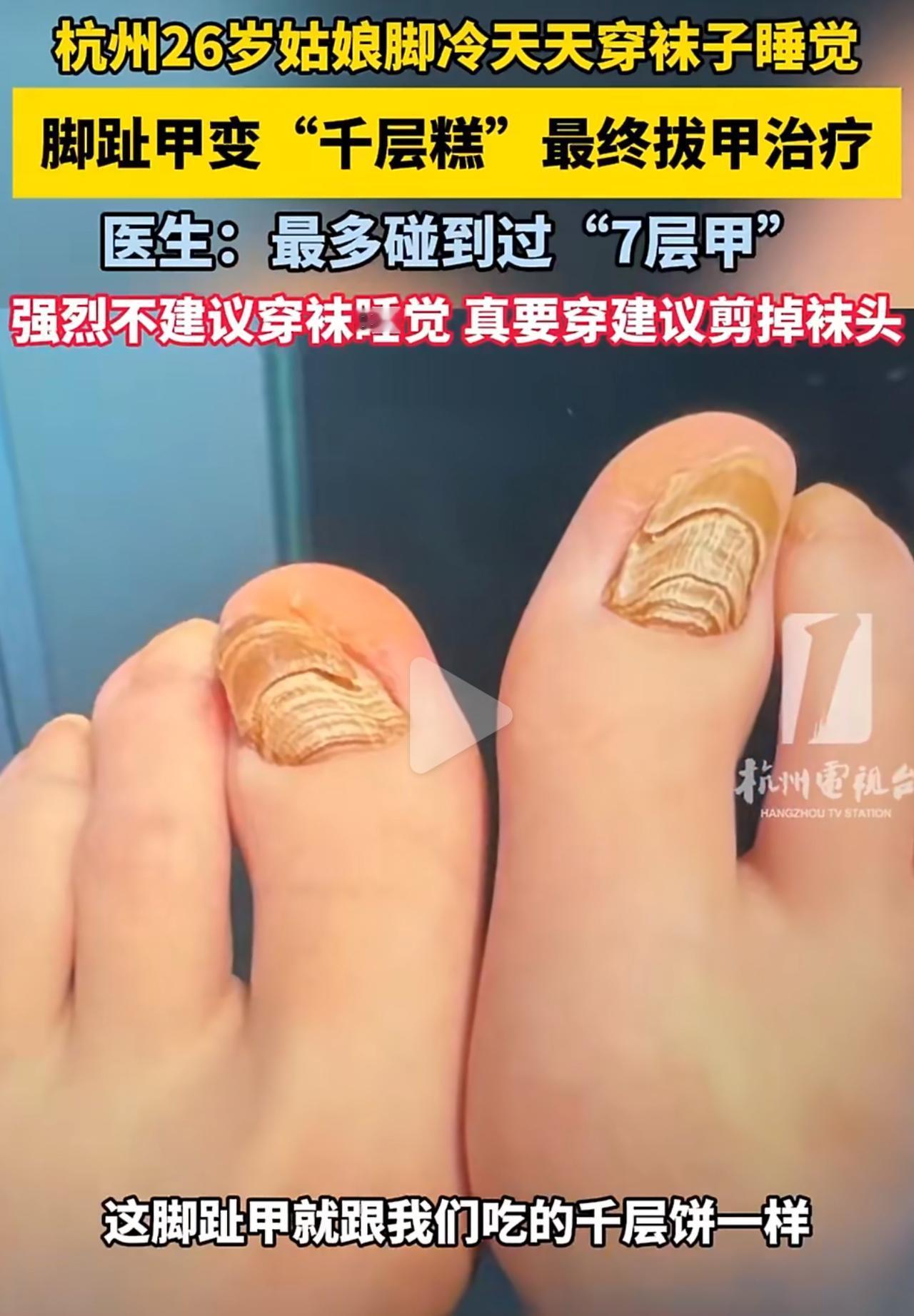 女生天生手脚冰凉，为了晚上能睡暖和，一整年都穿着紧绷的袜子睡觉。刚开始只觉得晚上