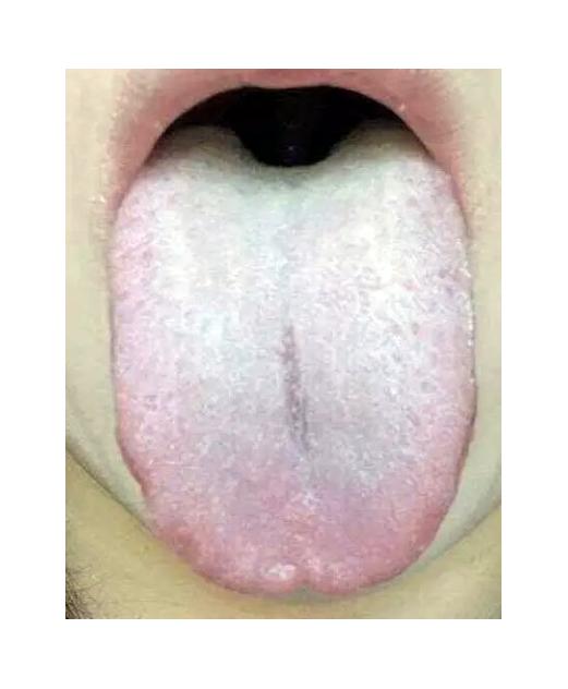 下午继续，伸舌我看！全程不收费！一个不漏，1分钟告知病因和调理方向！

舌苔白厚