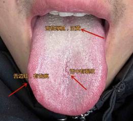 一味的用苦寒之药清热祛湿，反而更严重了，这种舌象可不仅仅是湿热
 
患者情况：腰