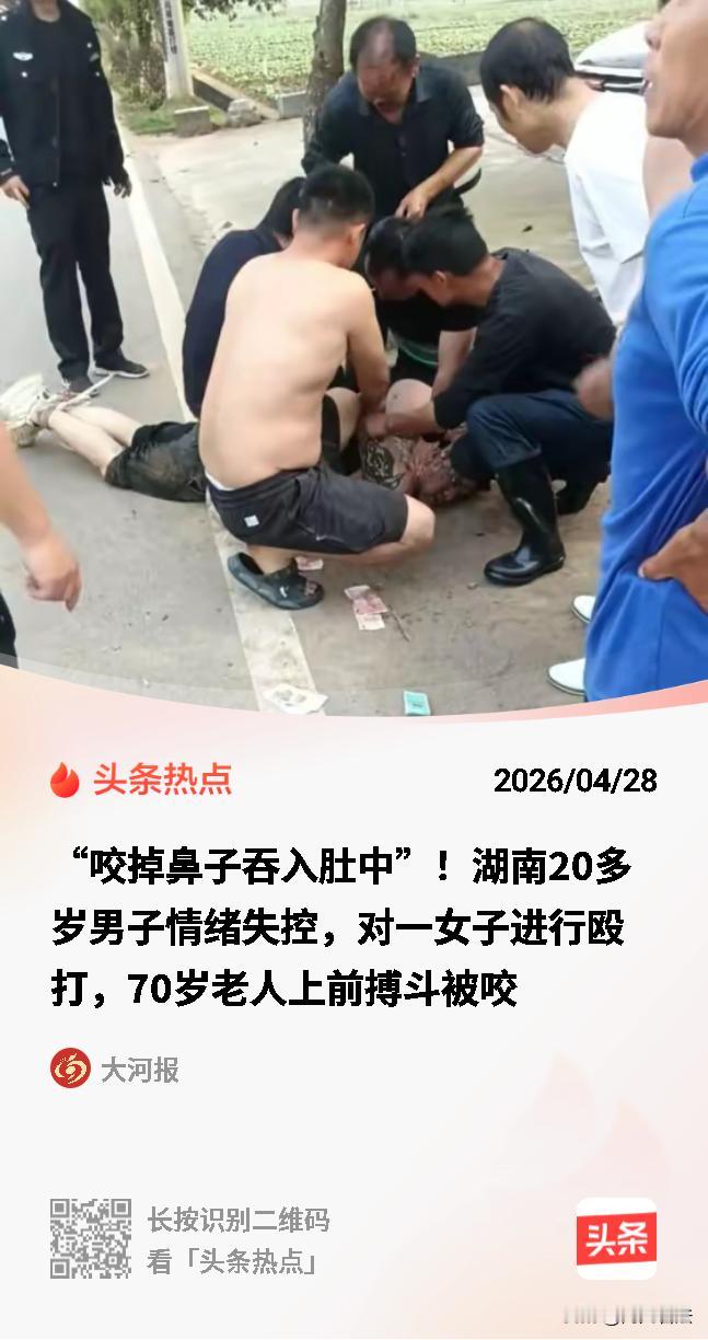 湖南7旬老汉勇斗歹徒被咬掉鼻子。医生：需做4次手术，从耳朵取肉移植。家属却为手术