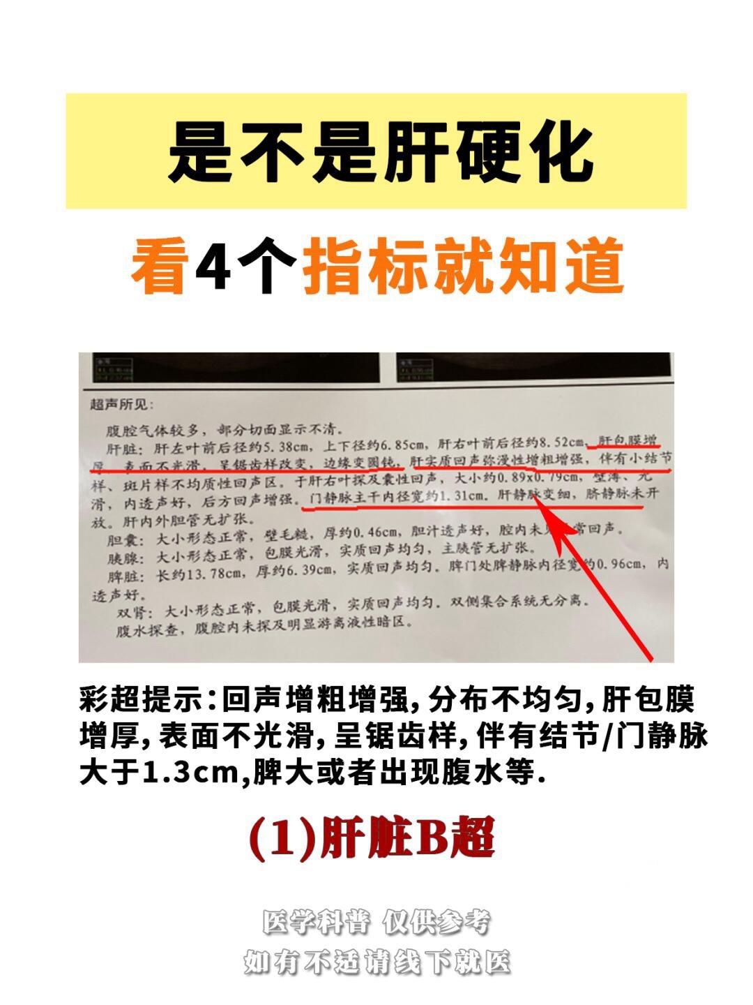 是不是肝硬化，看4个指标就知道。