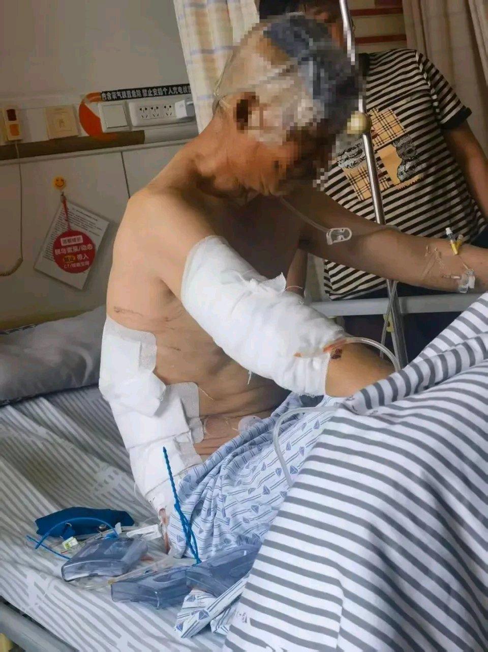 6月14日，距离黑龙江伊春南岔县徐大爷被黑熊袭击已过去37天。5月8日，60多岁