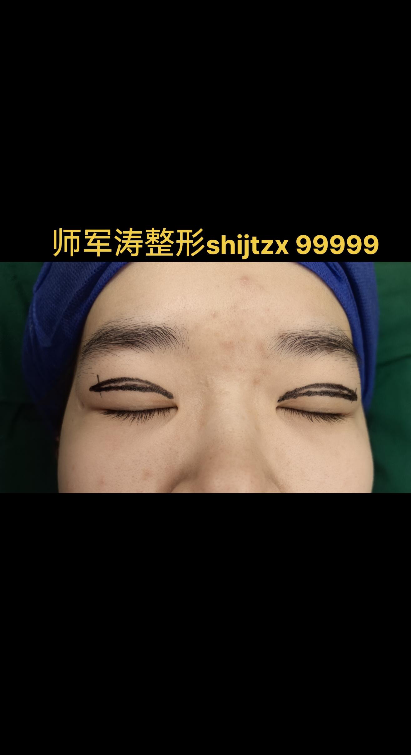 眼部整形术前。美容手术前的设计划线很重要，是思路、审美、术中修正的参照。