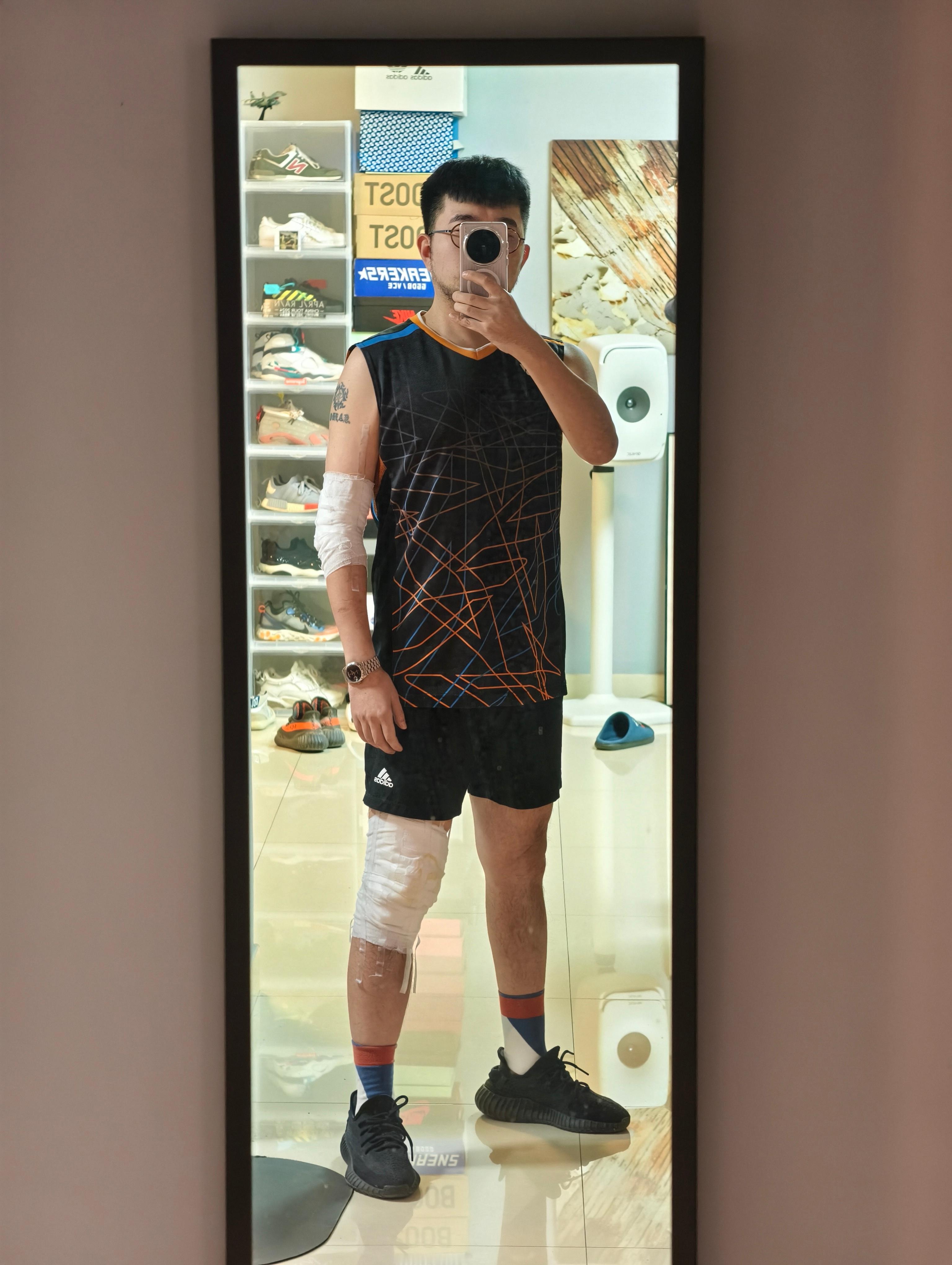战损限定版……总之就是长这么大第一次包扎这么大面积，最近铁也是肯定撸不了了，慢慢