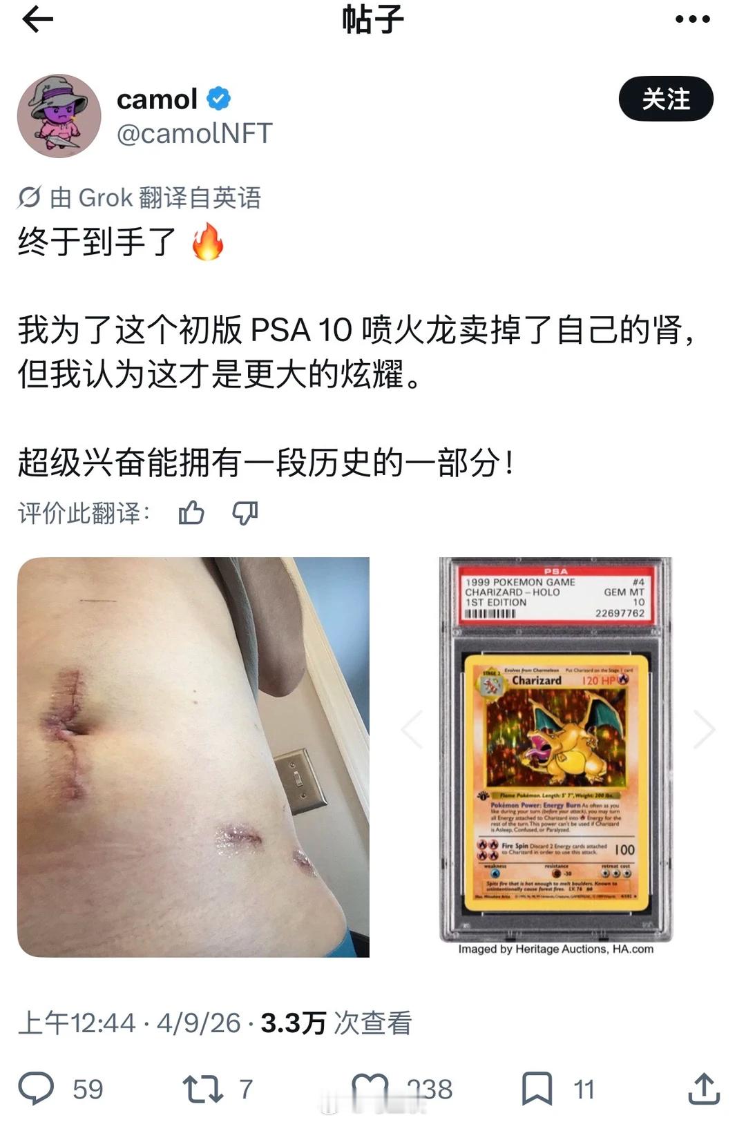 为了一张宝可梦卡片卖掉了自己的肾？这也太痴了… 