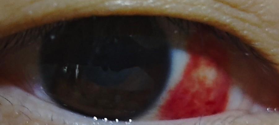 今天下午忽然发现右眼充血了，之前就有过一次，睡一觉起来就好了，今天又这样，不痛不