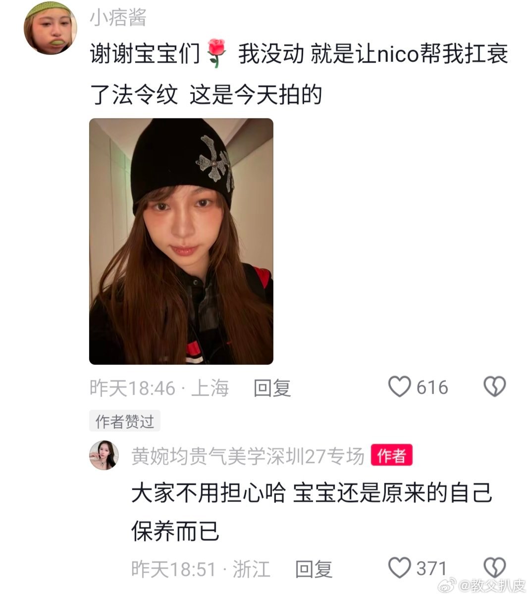 痞幼做医美了痞幼自己认证了，最近做了法令纹的抗衰微调，说是为了维持年轻状态，不是