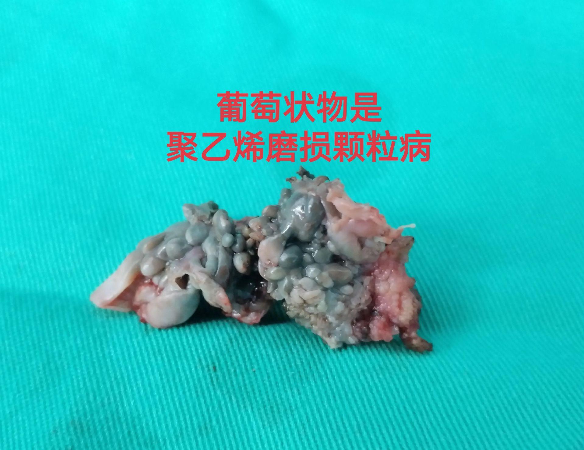 髋关节翻修。髋关节置换术后（外院）4年，磨损颗粒导致的无菌性松动，一期翻修，2天下床活动。磨损有好多因素，材质、体重、活动量等等。