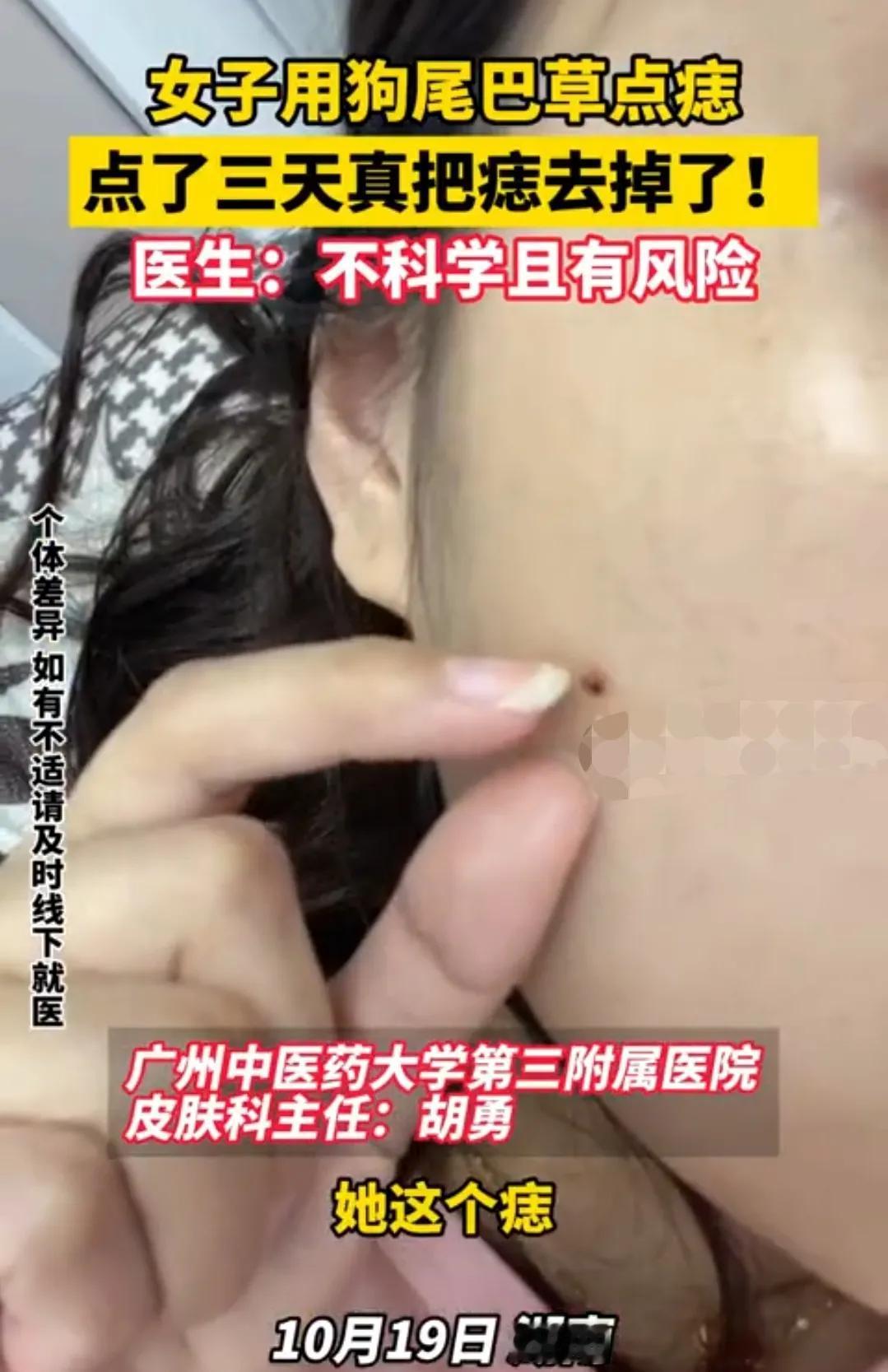 成功了？这个女孩居然用狗尾草点痣。医生:有风险
爱美的女生都喜欢点痣，我在锦州上