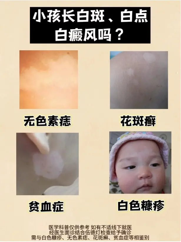 白癜风 白斑 白癜风科普 皮肤 硬核健康科普行动