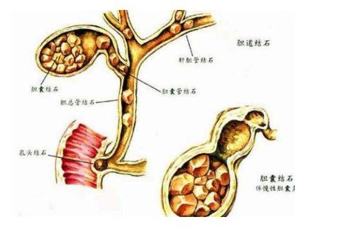 胖了容易胆结石，瘦太快也容易？胆囊最怕两个极端
 
很多人以为胆结石跟减肥没关系