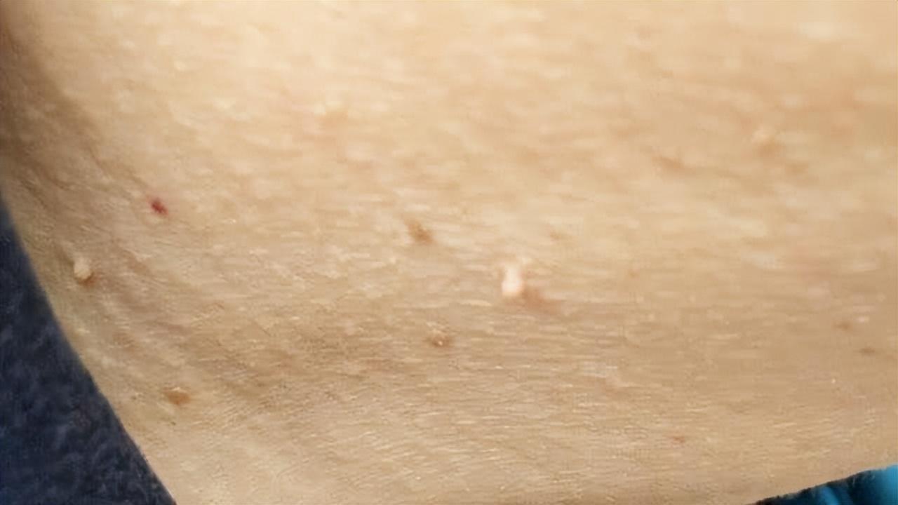 无论男女，皮肤出现这3个症状，多半是HPV缠身了，尽快检查医治

皮肤上突然冒出