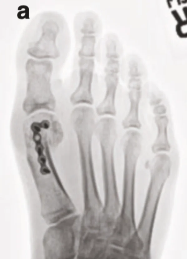 拇外翻手术常见的并发症1