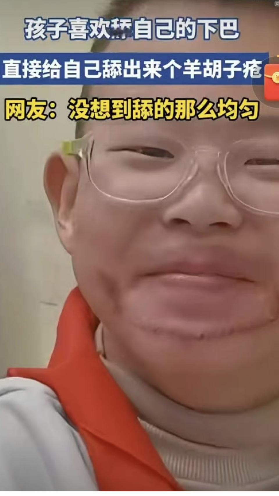 孩子不能老舔嘴巴
近日，浙江一小孩哥喜欢舔自己的下巴，直接给自己舔出来个羊胡子疮