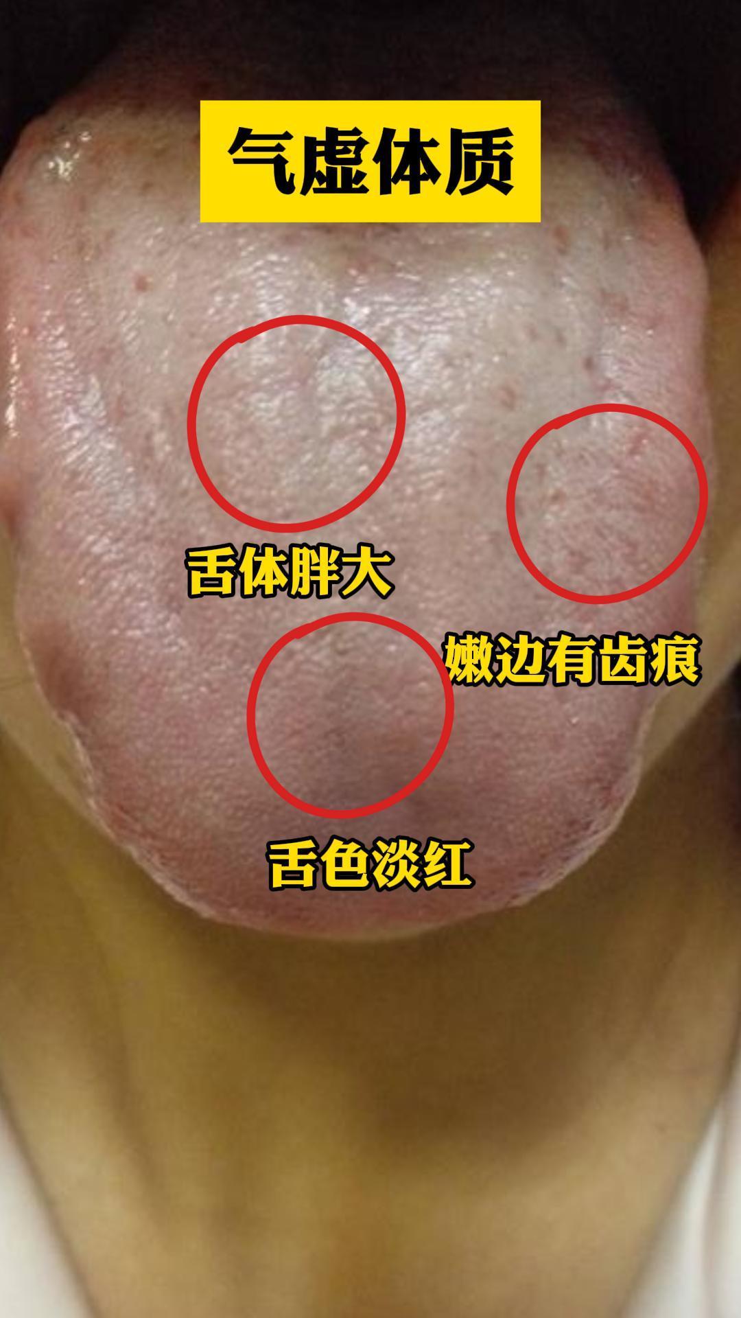 看舌辨别身体三大虚
气虚体质：
舌苔症状：舌色淡红，舌体胖大，边有齿痕。
分析：气虚质的患者通常因为气虚无力推动血液循环，导致舌体得不到足够的血液滋养而显得胖大。舌色淡红表明血液运行不畅。
体质特点：这类患者常感疲倦乏力，容易出汗，呼吸短促，声音低微，对环境的适应能力较差。
 
湿热体质：
舌苔症状：舌质偏红，舌苔黄腻。
分析：湿热质的患者体内湿热较重，舌质偏红反映了热邪的存在，而舌苔黄腻则是湿热熏蒸于舌面的表现。黄腻苔通常表示体内有湿热蕴结，可能导致口干口苦、大便黏滞不爽等症状。
体质特点：这类患者面部和
